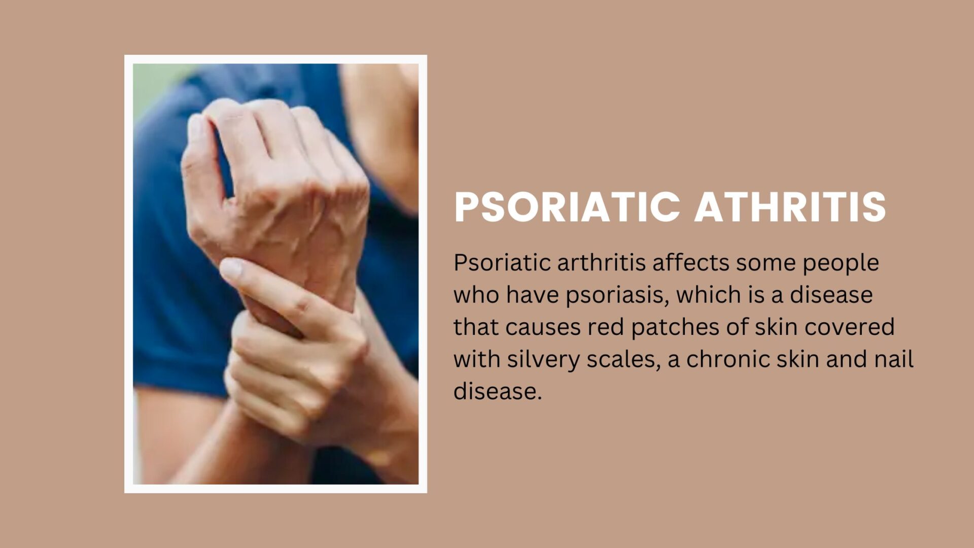 Psoriatic Arthritis Symptoms: Signs and Signals to Watch For